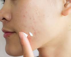 acne treatment pune 