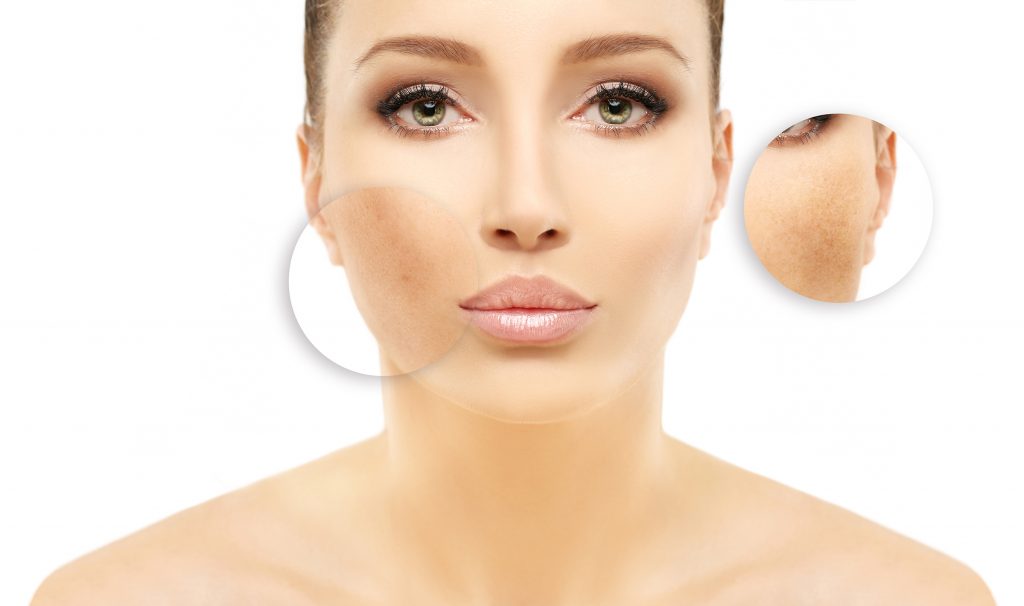 Pigmentation removal from skin